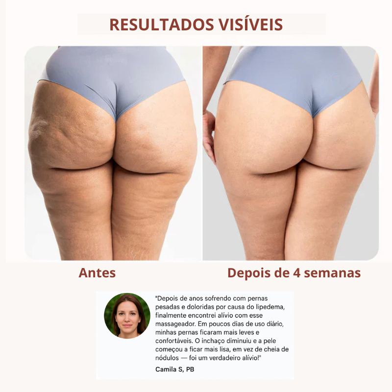 Drena Roller – Massageador Linfático para Lipedema e Celulite